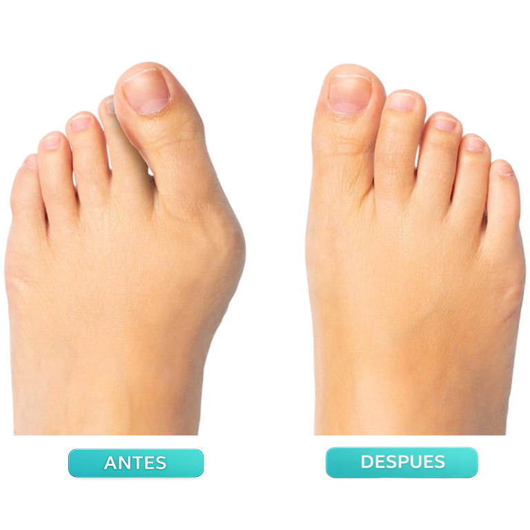 👣 CORRECTOR DE JUANETE AJUSTABLE ORTOPÉDICO